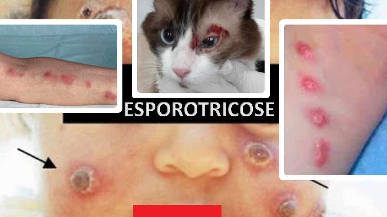 Esporotricose humana: recomendações da Sociedade Brasileira de Dermatologia  para o manejo clínico, diagnóstico e terapêutico